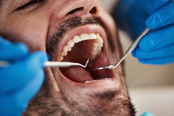 Best Emergency Tooth Extraction in West Park, FL